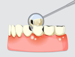 Periodontal treatment