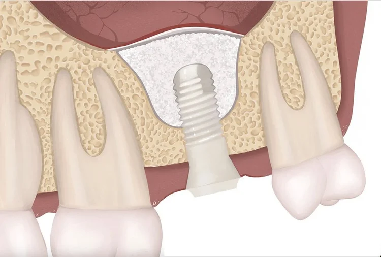 dental implants?