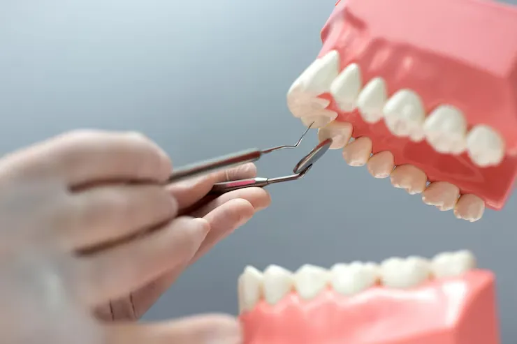 Crown Lengthening Surgery